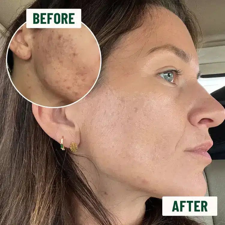 A specified skin care regimen help with clog pores, reduce acne scars, in the hair follicles, from oral contraceptive pills