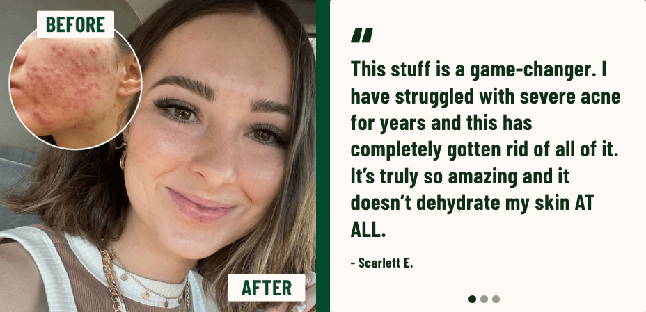 PCOS acne natural remedies