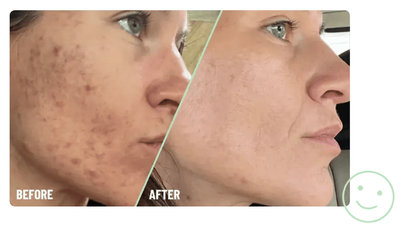 What are the ingredients in phyla acne?