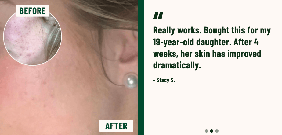 how to get rid of pcos of acne